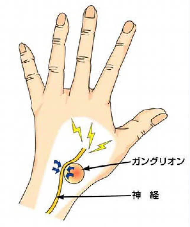ガングリオンの症状